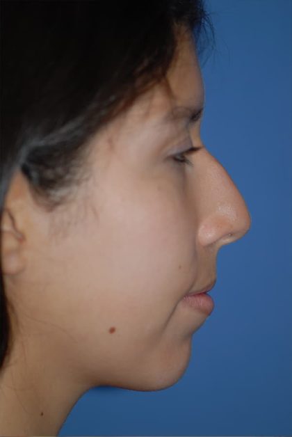 Rhinoplasty Before & After Patient #1594