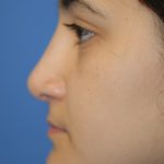 Rhinoplasty Before & After Patient #1593