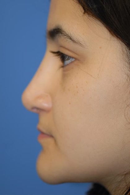 Rhinoplasty Before & After Patient #1593