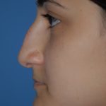 Rhinoplasty Before & After Patient #1593