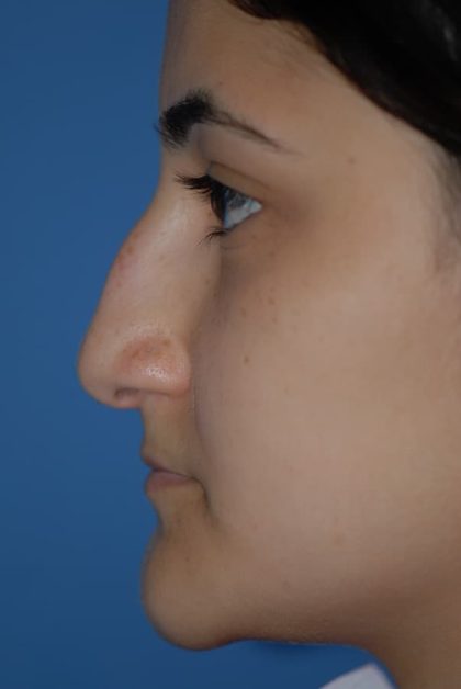 Rhinoplasty Before & After Patient #1593
