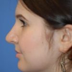 Rhinoplasty Before & After Patient #1592
