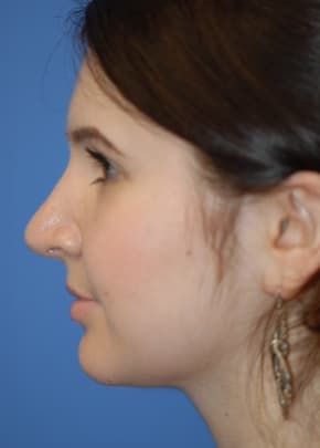 Rhinoplasty Before & After Patient #1592