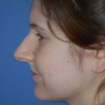 Rhinoplasty Before & After Patient #1592
