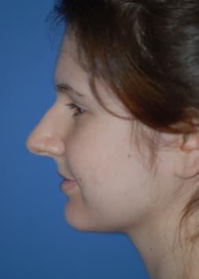 Rhinoplasty Before & After Patient #1592