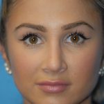 Rhinoplasty Before & After Patient #1591