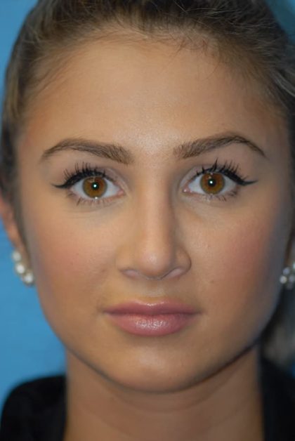 Rhinoplasty Before & After Patient #1591