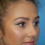 Rhinoplasty Before & After Patient #1591