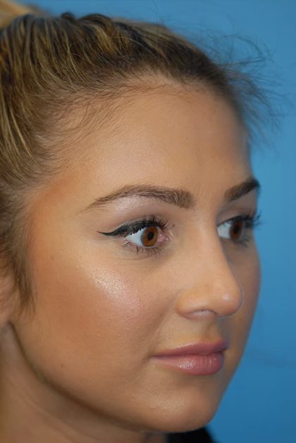 Rhinoplasty Before & After Patient #1591