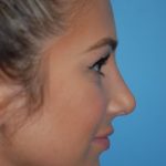 Rhinoplasty Before & After Patient #1591