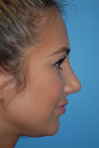 Rhinoplasty Before & After Patient #1591
