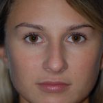 Rhinoplasty Before & After Patient #1591