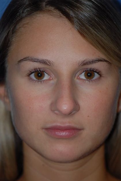 Rhinoplasty Before & After Patient #1591