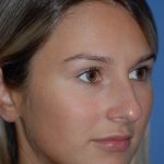 Rhinoplasty Before & After Patient #1591