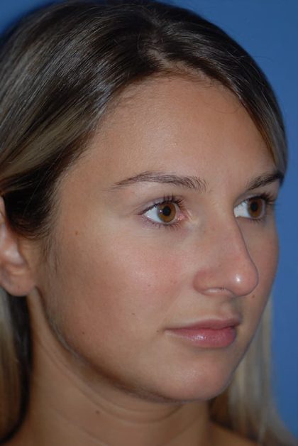 Rhinoplasty Before & After Patient #1591