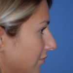 Rhinoplasty Before & After Patient #1591