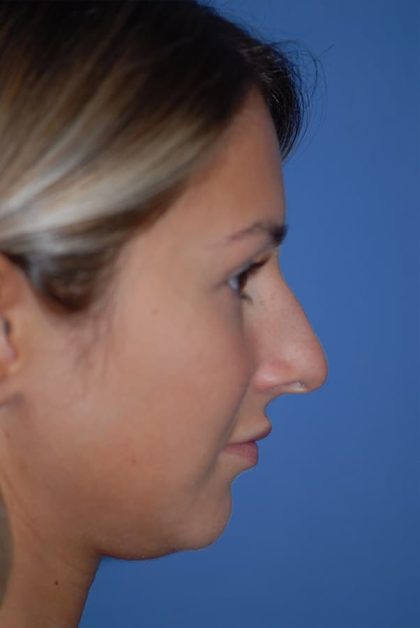 Rhinoplasty Before & After Patient #1591