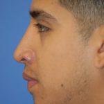 Rhinoplasty Before & After Patient #1590