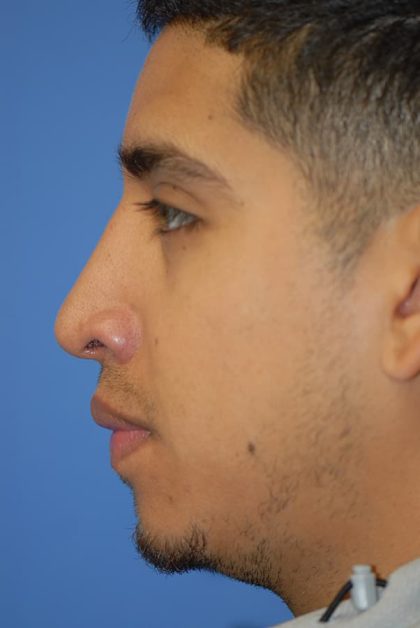 Rhinoplasty Before & After Patient #1590