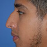 Rhinoplasty Before & After Patient #1590