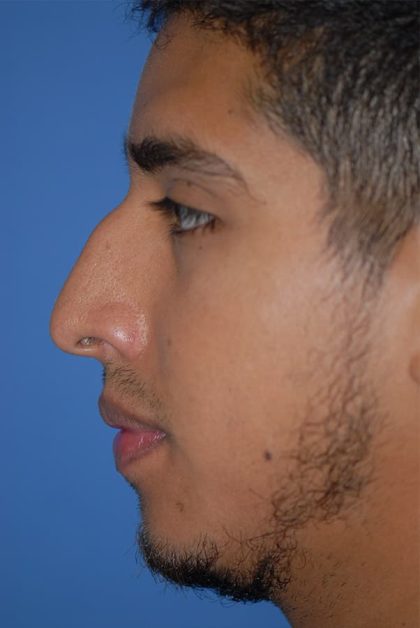 Rhinoplasty Before & After Patient #1590