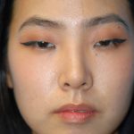 Rhinoplasty Before & After Patient #1589
