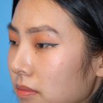Rhinoplasty Before & After Patient #1589