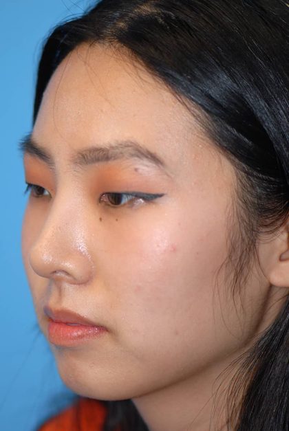 Rhinoplasty Before & After Patient #1589