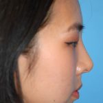Rhinoplasty Before & After Patient #1589