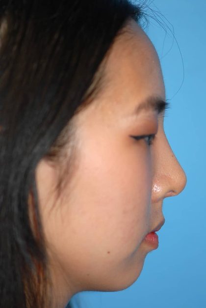 Rhinoplasty Before & After Patient #1589