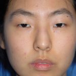 Rhinoplasty Before & After Patient #1589