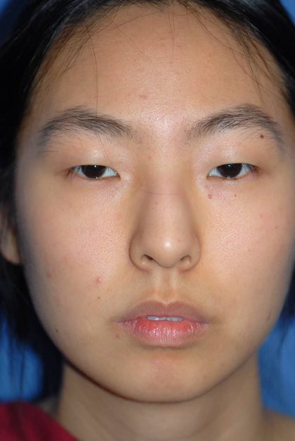 Rhinoplasty Before & After Patient #1589