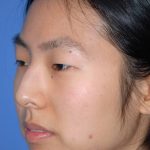 Rhinoplasty Before & After Patient #1589