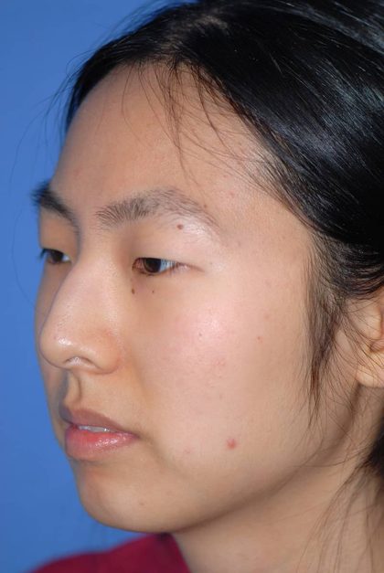 Rhinoplasty Before & After Patient #1589