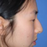 Rhinoplasty Before & After Patient #1589