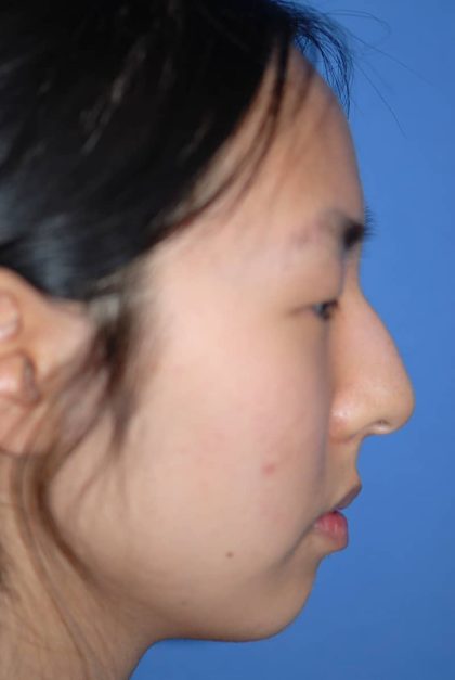 Rhinoplasty Before & After Patient #1589