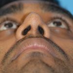 Rhinoplasty Before & After Patient #1588
