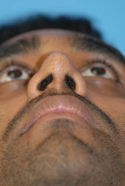Rhinoplasty Before & After Patient #1588
