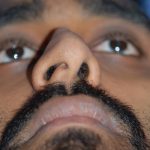 Rhinoplasty Before & After Patient #1588