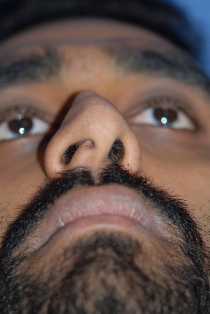 Rhinoplasty Before & After Patient #1588