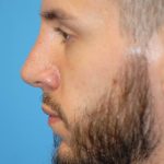 Rhinoplasty Before & After Patient #1587