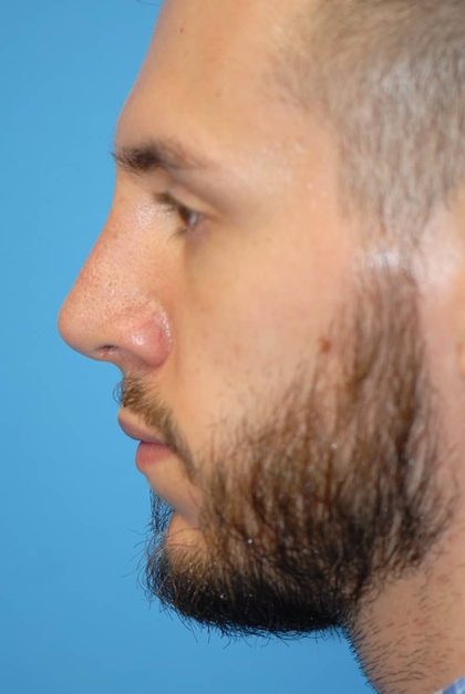 Rhinoplasty Before & After Patient #1587