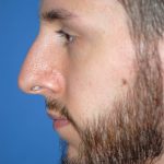 Rhinoplasty Before & After Patient #1587