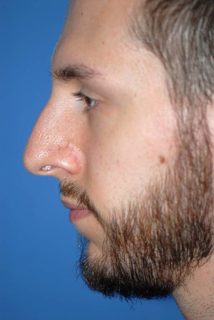 Rhinoplasty Before & After Patient #1587