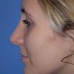 Rhinoplasty Before & After Patient #1586