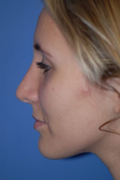 Rhinoplasty Before & After Patient #1586