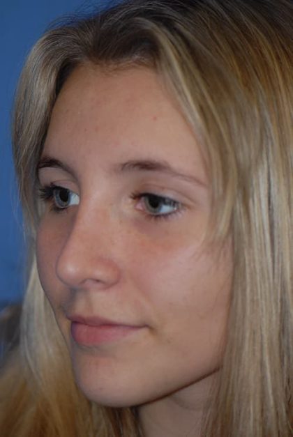 Rhinoplasty Before & After Patient #1586