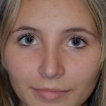 Rhinoplasty Before & After Patient #1586