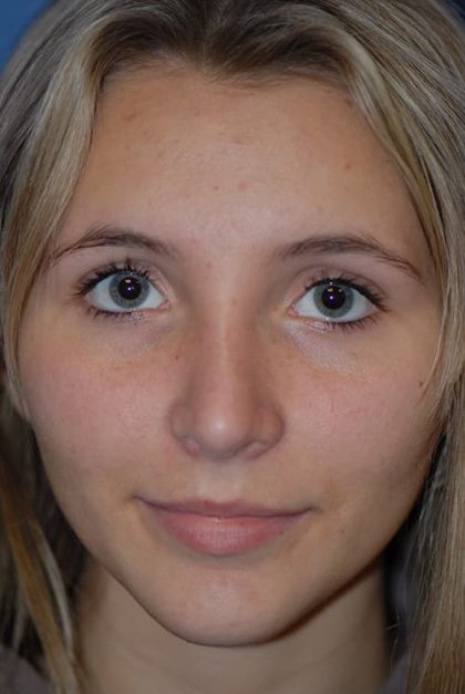 Rhinoplasty Before & After Patient #1586
