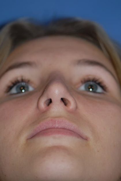 Rhinoplasty Before & After Patient #1586